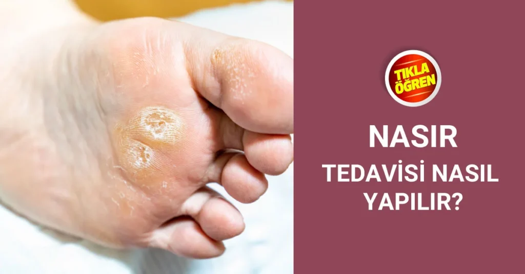 Nasır oluşumu ve tedavisine dair bilgilere yer verilmektedir.