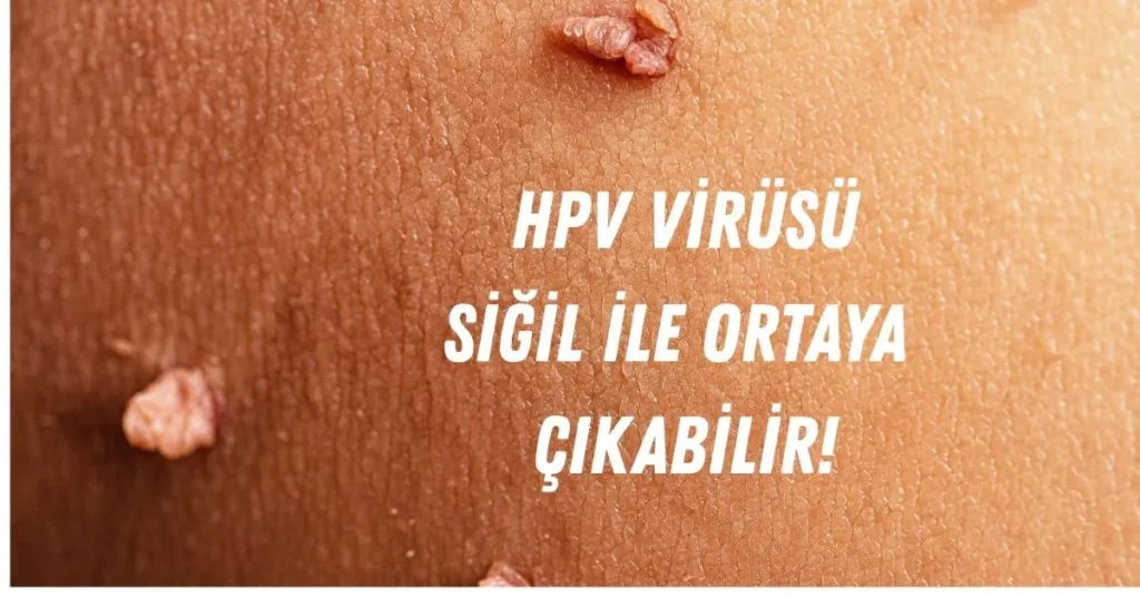 Siğillerin ana nedeni bulaşıcı olan HPV Human Papilloma Virus olup mutlaka önlem alınmalıdır.